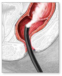 rectum