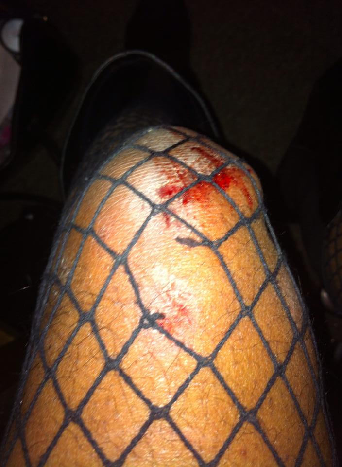 Adé Connere's bloody knee after a violent altercation on Capitol Hill. This attack and others has led to a call for action to fight back against perceived increased street crimes and hate crimes on Capitol Hill. Photo: Ade Connere.